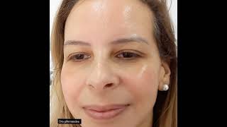 Tratamento para Melasma dragifernandes [upl. by Evanthe823]