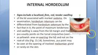 Ophthalmology 378 Internal Hordeolum Meibomian gland infection [upl. by Adnola651]