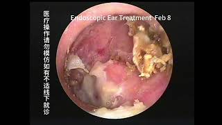 Two cases of cholesteatoma with significant differences [upl. by Llennhoj260]