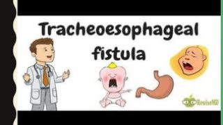 Pediatric Lec 3 Esophageal Atresia [upl. by Lener]