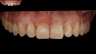 Invisalign course Protocols to perform a Perfect rotation [upl. by Normak646]