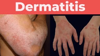 What is Dermatitis A complete guide about Dermatitis [upl. by Bornstein]