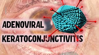 VIRAL CONJUNCTIVITIS  Ultimate Guide to Recognising Clinical Presentations [upl. by Morty]