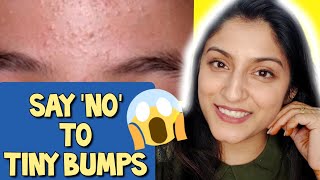 7 Days Challenge 😲 Treat TINY BUMPS on FOREHEADSFACE NATURALLY  100 Works Home Remedy [upl. by Atla155]