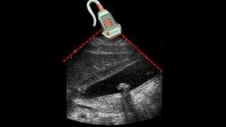 Ultrasound of Gallbladder amp Gallstone [upl. by Ocire]