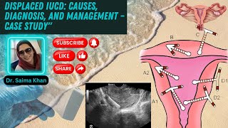 Displaced IUCD Causes Diagnosis and Management – Case Study healthytips DrSaimakhan [upl. by Hardunn314]