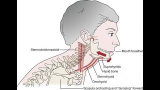 A common cause of TMD Suprahyoid muscle clenching [upl. by Charissa]