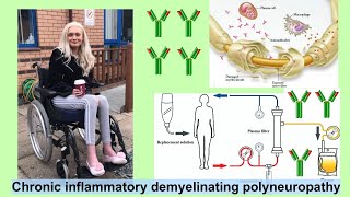 chronic inflammatory demyelinating polyneuropathy [upl. by Quintana]