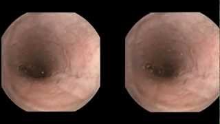 Esophageal varices detected by capsule endoscopy [upl. by Kemeny]