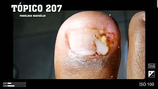 UNHA ENCRAVADA E INFLAMADA INFECTED INGROWN NAIL  PODÓLOGO MAURÉLIO [upl. by Medorra700]