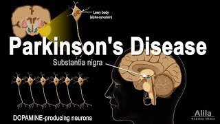 Parkinsons Disease Animation [upl. by Halullat]