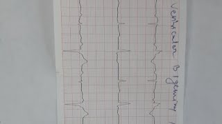 ventricular bigeminy and trigeminy [upl. by Danica]