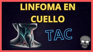 LINFOMA en el CUELLO👉Hallazgos en TOMOGRAFÍA [upl. by Glasgo]