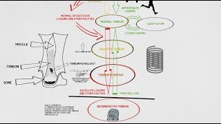 Tendinopathy Continuum and Update [upl. by Lehcnom]