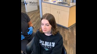 Braces Removal Time lapse  Braces and Invisalign  Omaha NE [upl. by Cotter]