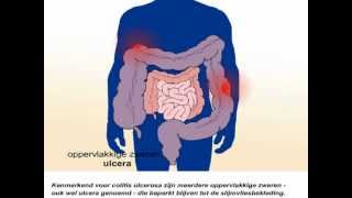 Colitis ulcerosa  Wat zijn de symptomen en behandeling van colitis ulcerosa [upl. by Halona]