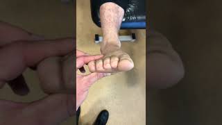 Assessing forefoot Valgus [upl. by Hteb392]