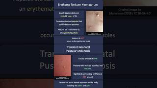 Erythema Toxicum Neonatorum vs Transient Neonatal Pustular Melanosis [upl. by Nahsyar289]