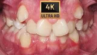 HOW BRACES WORK  TIMELAPSE of ECTOPIC CANINES  four premolars extraction case Orthodontics [upl. by Imak]