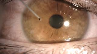 corneal foreign body removal like a boss [upl. by Eylloh]