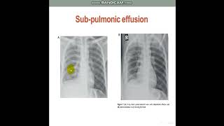 PleuralEffusionDiagnosticApproach [upl. by Ttayh145]