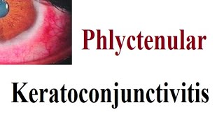 phlyctenular Keratoconjunctivitis [upl. by Scrivings803]