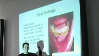 tobacco smoking and oral mouth cancer  a case study [upl. by Htebilil]