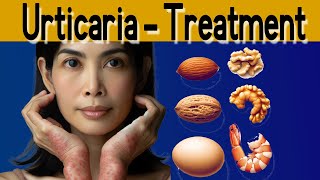 Urticaria symptoms causes treatment and prevention [upl. by Ramses]