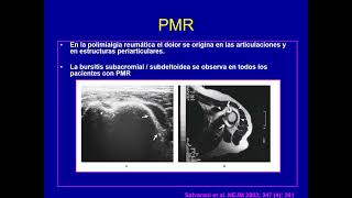 polimialgia reumatica y arteritis de celulas gigantes Horacio Di Fonzo [upl. by Aissilem]