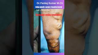 Best varicose veins treatment Laser treatment of varicose veinsvaricose veins treatment in Ranchi [upl. by Dnar599]