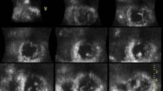 ACUTE MYOCARDIAL INFARCTION ANTEROSEPTAL 3D ECHOCARDIOGRAPHY cardiac ultrasound [upl. by Marrin]