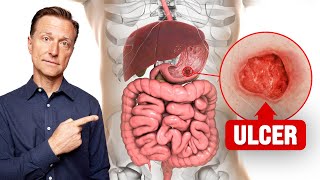 The FASTEST Way to Heal an Ulcer [upl. by Harhay]