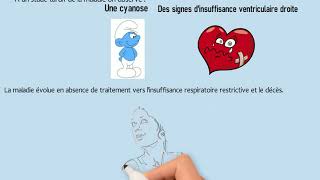 Tout Savoir Sur La Fibrose Pulmonaire Idiopathique [upl. by Keen257]