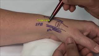 1st CMC Joint Injection [upl. by Nihsfa]