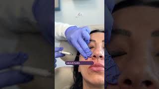 Botox Treatment amp Lip Filler Injections for Victoria  Aesthetics [upl. by Burger]