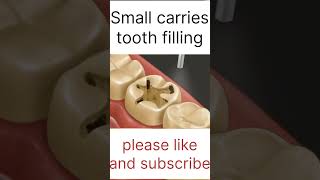 Small carries tooth filling asmr 3d localdentistry cavityfilling youtubeshorts ytshortsindia [upl. by Githens352]