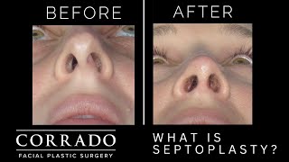 What is a Deviated Septum and How Does a Septoplasty Surgery Help  Dr Anthony Corrado [upl. by Van37]