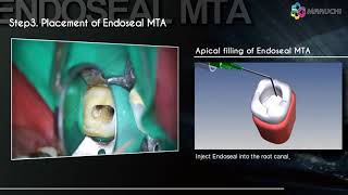 Endoseal MTA [upl. by Larimor]