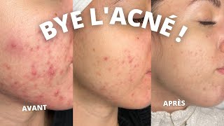 COMMENT SE DÉBARRASSER DE LACNÉ  MA ROUTINE SKINCARE [upl. by Quincey48]