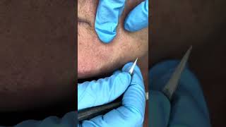 Watch Electrolysis Hair Removal in Action [upl. by Durning]