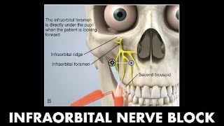 4B  Infraorbital Nerve Block Dr Demetrick LeCorn [upl. by Pelletier737]