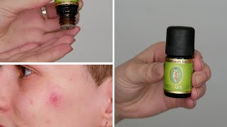 Can you apply Tea Tree Oil directly to Acne Pimple  Here is what happened to me [upl. by Noleta457]