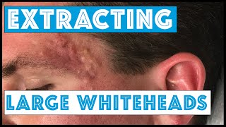 Acne Vulgaris and Extracting large Whiteheads  Part 1 [upl. by Eillib]