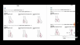 Fracture classification Part 2 by DrAnkita Gautam Assistant professor physiotherapy Rpiit [upl. by Yklam]