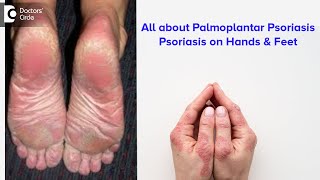 All about Palmoplantar Psoriasis  Psoriasis on hands amp feet  Dr Rajdeep Mysore  Doctors Circle [upl. by Jard]