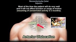 Sternoclavicular Joint Injuries  Everything You Need To Know  Dr Nabil Ebraheim [upl. by Elbertine816]