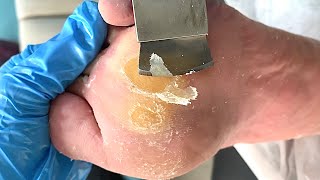 Callus removal from feetampFoot scraping dead skin【Xiao Yan pedicure】stress 630 [upl. by Ydnagrub]