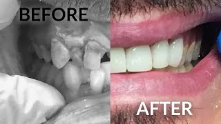 Dental Crown Procedure  Before and After [upl. by Lerad703]