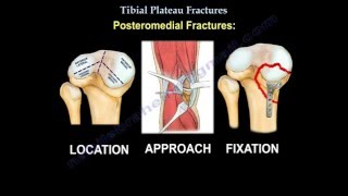 Tibial Plateau Fractures  Everything You Need To Know  Dr Nabil Ebraheim [upl. by Moritz]