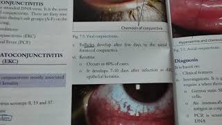 epidemic keratoconjunctivitis opthamology [upl. by Kerat]